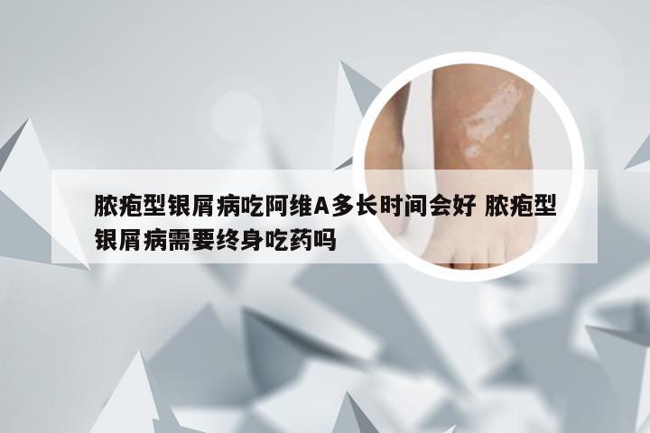 脓疱型银屑病吃阿维A多长时间会好 脓疱型银屑病需要终身吃药吗
