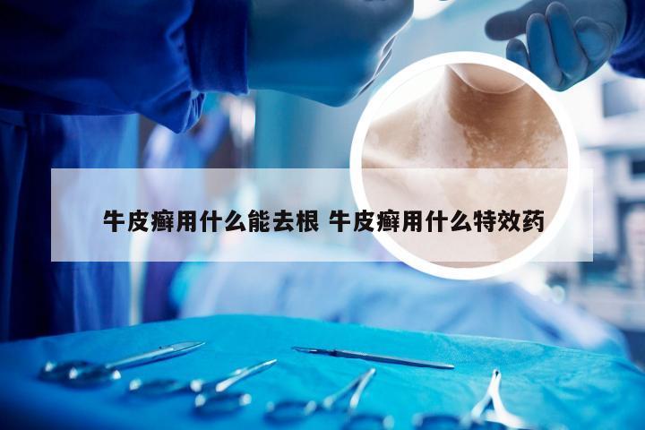 牛皮癣用什么能去根 牛皮癣用什么特效药