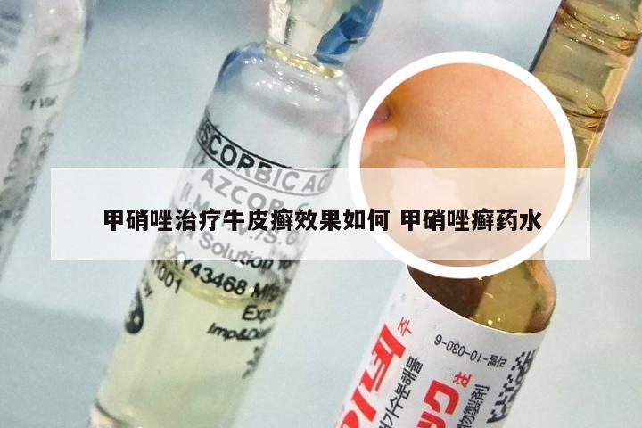 甲硝唑治疗牛皮癣效果如何 甲硝唑癣药水