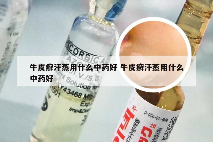 牛皮癣汗蒸用什么中药好 牛皮癣汗蒸用什么中药好