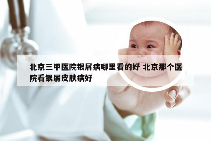 北京三甲医院银屑病哪里看的好 北京那个医院看银屑皮肤病好