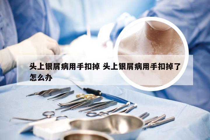 头上银屑病用手扣掉 头上银屑病用手扣掉了怎么办