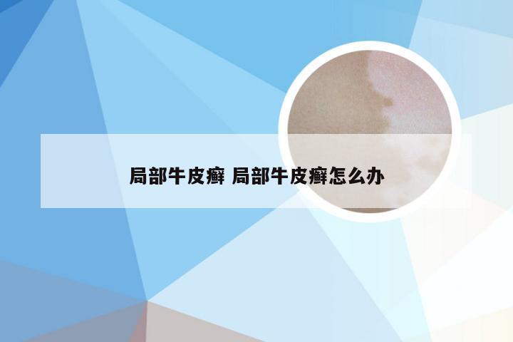 局部牛皮癣 局部牛皮癣怎么办