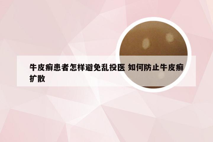 牛皮癣患者怎样避免乱投医 如何防止牛皮癣扩散