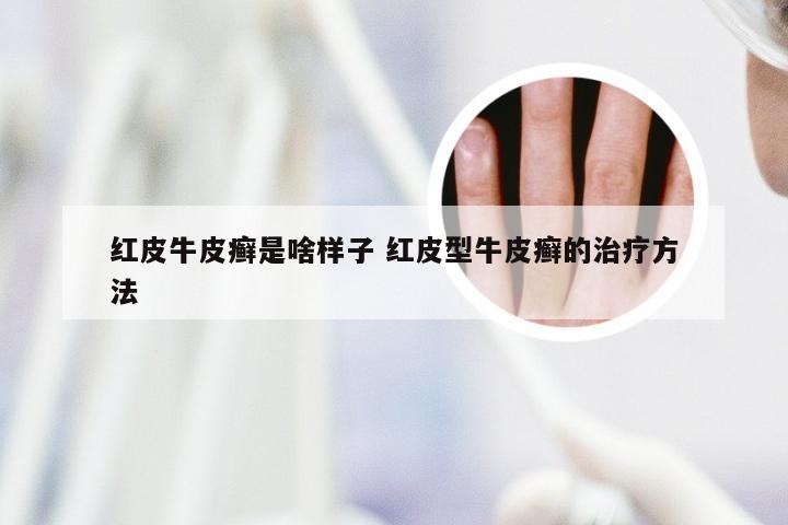红皮牛皮癣是啥样子 红皮型牛皮癣的治疗方法