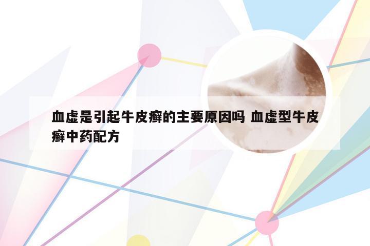 血虚是引起牛皮癣的主要原因吗 血虚型牛皮癣中药配方