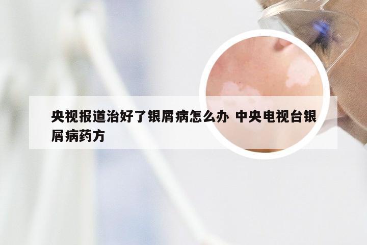 央视报道治好了银屑病怎么办 中央电视台银屑病药方