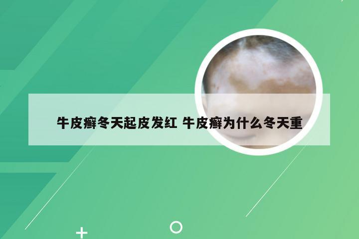 牛皮癣冬天起皮发红 牛皮癣为什么冬天重