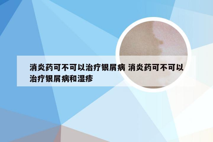 消炎药可不可以治疗银屑病 消炎药可不可以治疗银屑病和湿疹