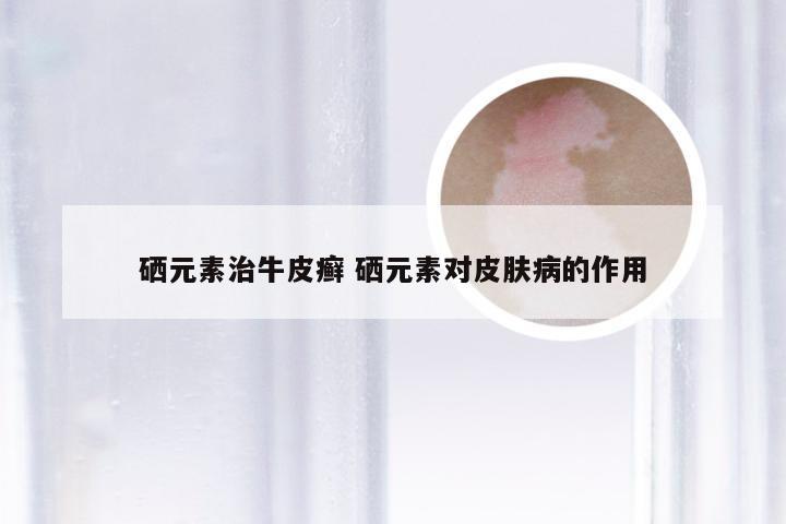 硒元素治牛皮癣 硒元素对皮肤病的作用