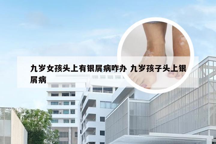 九岁女孩头上有银屑病咋办 九岁孩子头上银屑病