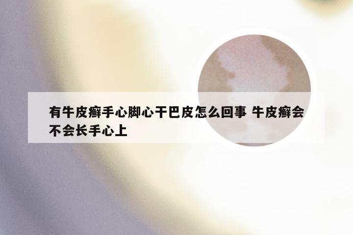 有牛皮癣手心脚心干巴皮怎么回事 牛皮癣会不会长手心上