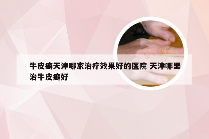 牛皮癣天津哪家治疗效果好的医院 天津哪里治牛皮癣好