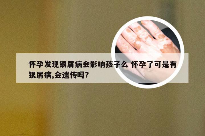怀孕发现银屑病会影响孩子么 怀孕了可是有银屑病,会遗传吗?