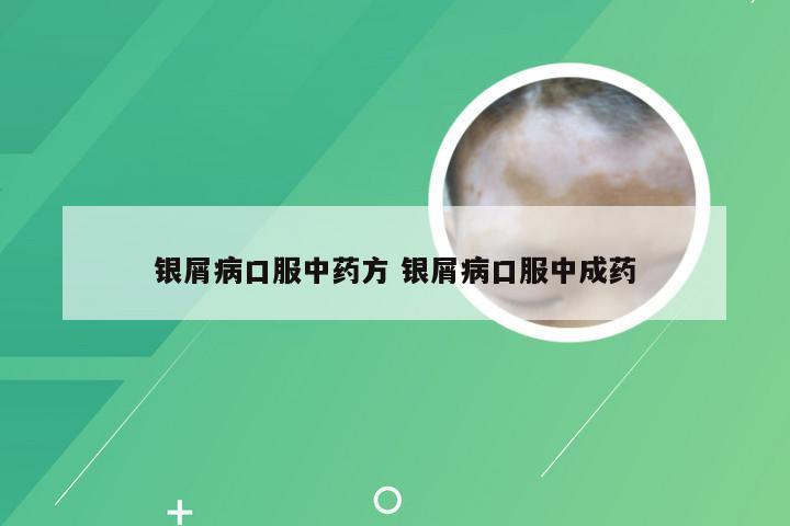 银屑病口服中药方 银屑病口服中成药