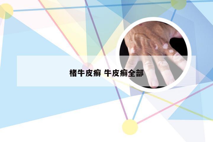 楮牛皮癣 牛皮癣全部