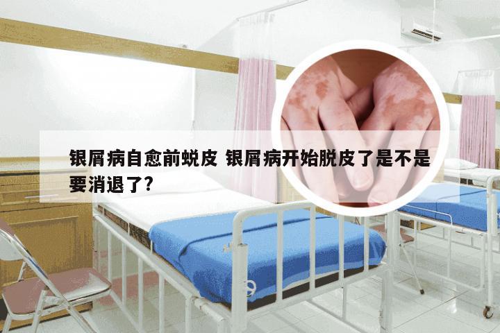 银屑病自愈前蜕皮 银屑病开始脱皮了是不是要消退了?