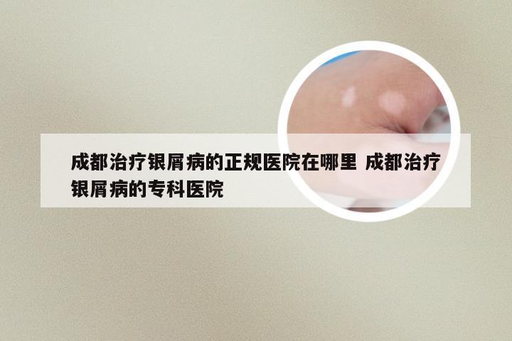 成都治疗银屑病的正规医院在哪里 成都治疗银屑病的专科医院