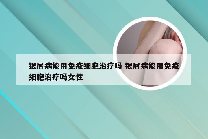 银屑病能用免疫细胞治疗吗 银屑病能用免疫细胞治疗吗女性