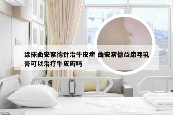 涂抹曲安奈德针治牛皮癣 曲安奈德益康唑乳膏可以治疗牛皮癣吗
