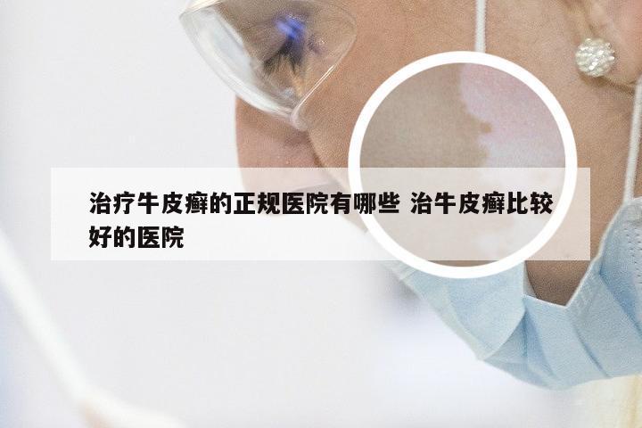 治疗牛皮癣的正规医院有哪些 治牛皮癣比较好的医院