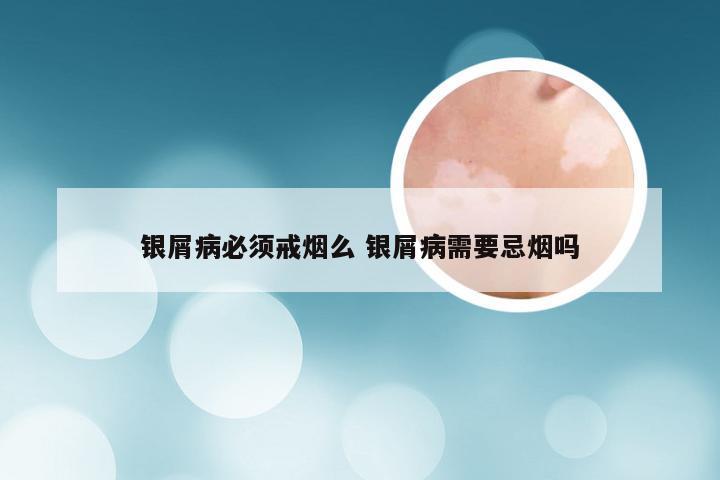 银屑病必须戒烟么 银屑病需要忌烟吗