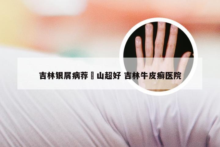 吉林银屑病荐崋山超好 吉林牛皮癣医院