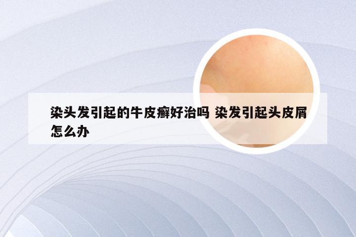 染头发引起的牛皮癣好治吗 染发引起头皮屑怎么办