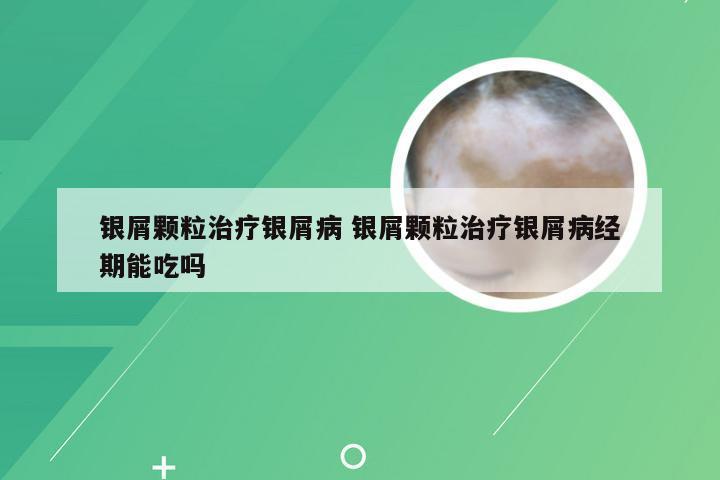 银屑颗粒治疗银屑病 银屑颗粒治疗银屑病经期能吃吗