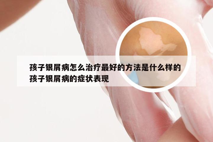 孩子银屑病怎么治疗最好的方法是什么样的 孩子银屑病的症状表现