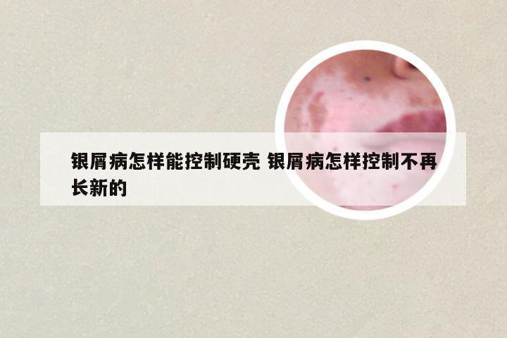 银屑病怎样能控制硬壳 银屑病怎样控制不再长新的