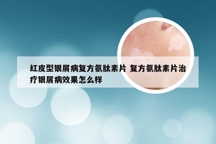 红皮型银屑病复方氨肽素片 复方氨肽素片治疗银屑病效果怎么样