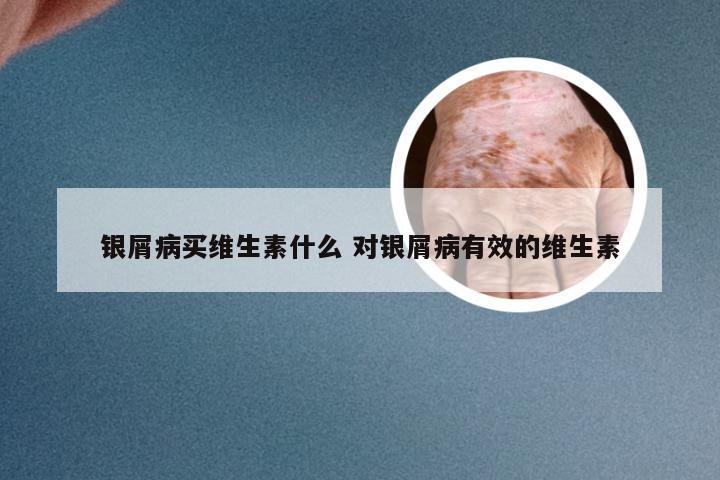 银屑病买维生素什么 对银屑病有效的维生素