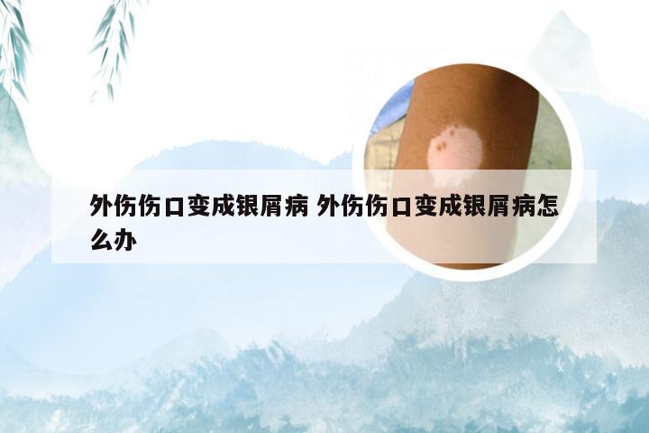 外伤伤口变成银屑病 外伤伤口变成银屑病怎么办