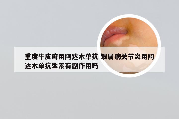 重度牛皮癣用阿达木单抗 银屑病关节炎用阿达木单抗生素有副作用吗