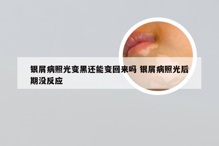 银屑病照光变黑还能变回来吗 银屑病照光后期没反应