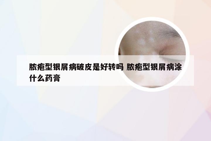 脓疱型银屑病破皮是好转吗 脓疱型银屑病涂什么药膏