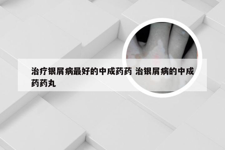 治疗银屑病最好的中成药药 治银屑病的中成药药丸
