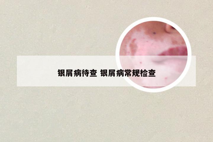 银屑病待查 银屑病常规检查