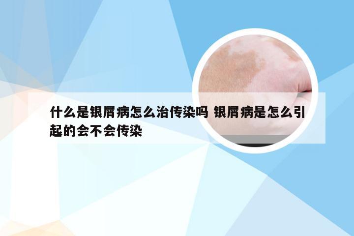 什么是银屑病怎么治传染吗 银屑病是怎么引起的会不会传染