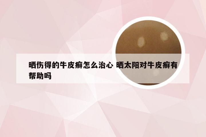 晒伤得的牛皮癣怎么治心 晒太阳对牛皮癣有帮助吗