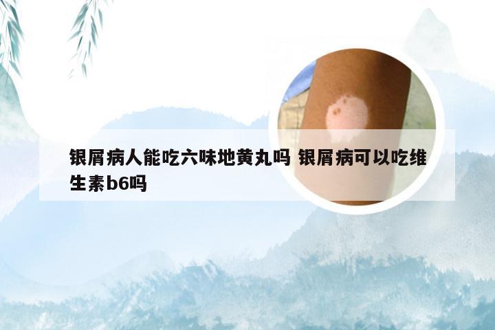 银屑病人能吃六味地黄丸吗 银屑病可以吃维生素b6吗