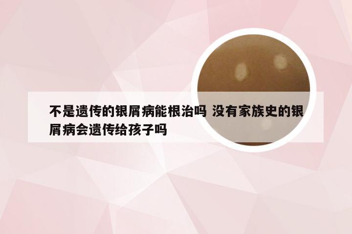 不是遗传的银屑病能根治吗 没有家族史的银屑病会遗传给孩子吗