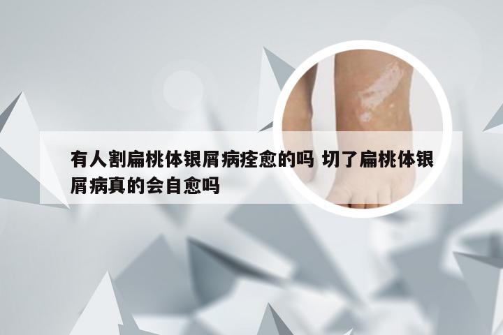 有人割扁桃体银屑病痊愈的吗 切了扁桃体银屑病真的会自愈吗