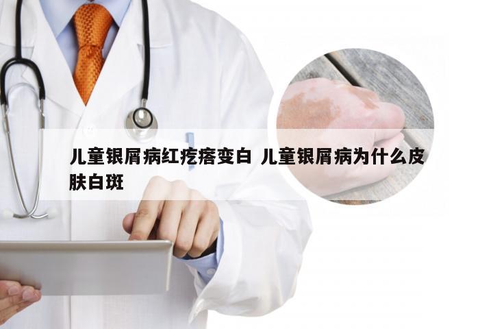儿童银屑病红疙瘩变白 儿童银屑病为什么皮肤白斑