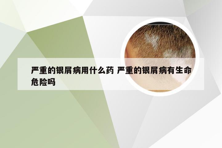严重的银屑病用什么药 严重的银屑病有生命危险吗