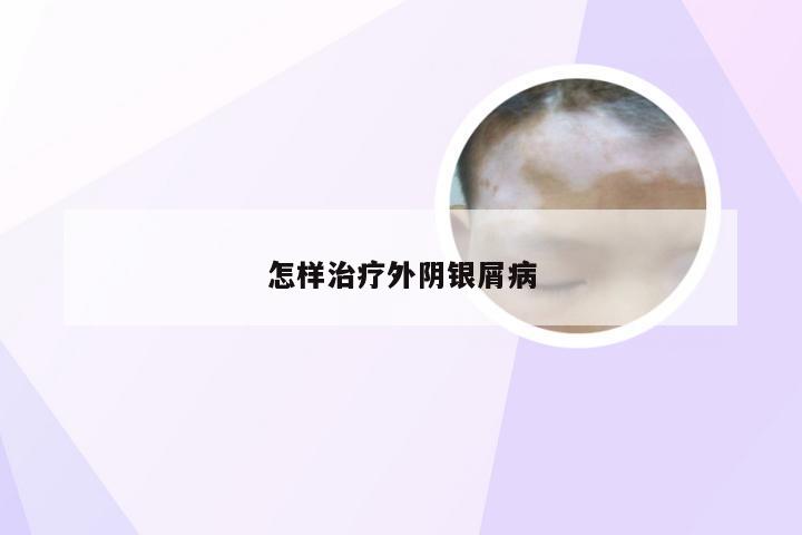 怎样治疗外阴银屑病