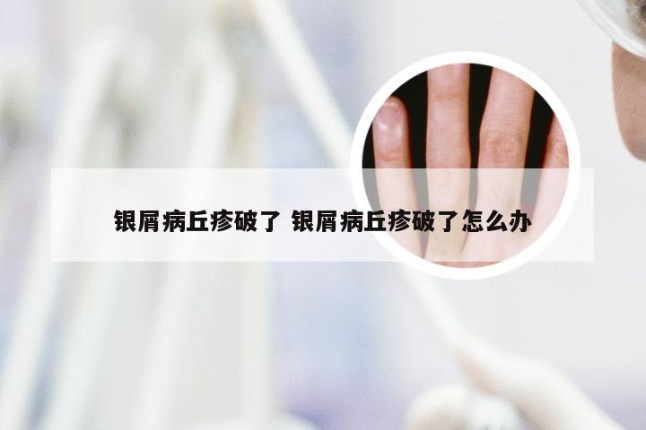 银屑病丘疹破了 银屑病丘疹破了怎么办