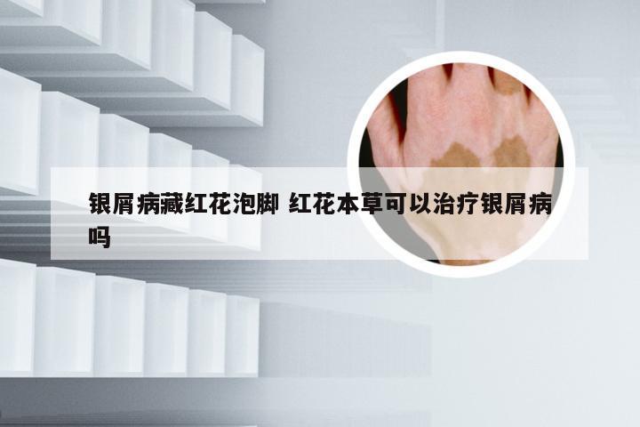 银屑病藏红花泡脚 红花本草可以治疗银屑病吗