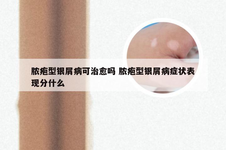 脓疱型银屑病可治愈吗 脓疱型银屑病症状表现分什么